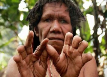 Finger Cutting of The Dani Tribe