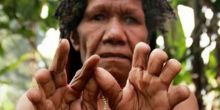 Finger Cutting of The Dani Tribe