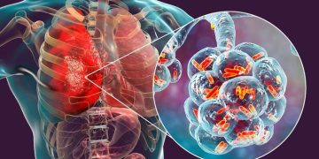 Tuberculosis Cases Indonesia