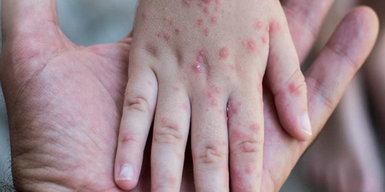 Measles Outbreak Sumenep